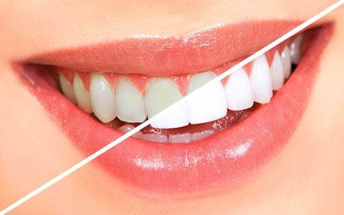 روش‌های طبیعی برای سفید کردن دندان‌ها