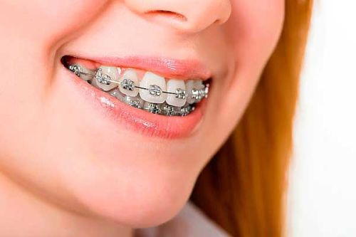 روش سفید کردن دندان‌ها بعد از ارتودنسی