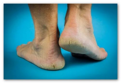 تشخیص خشکی پا